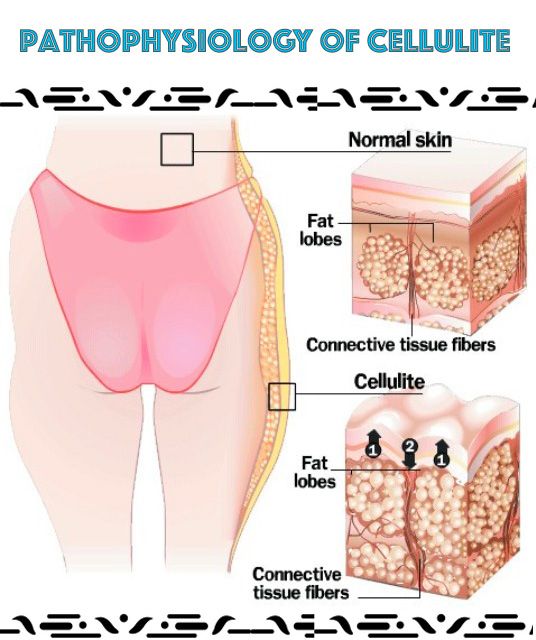 pathophysiology-cellulite.