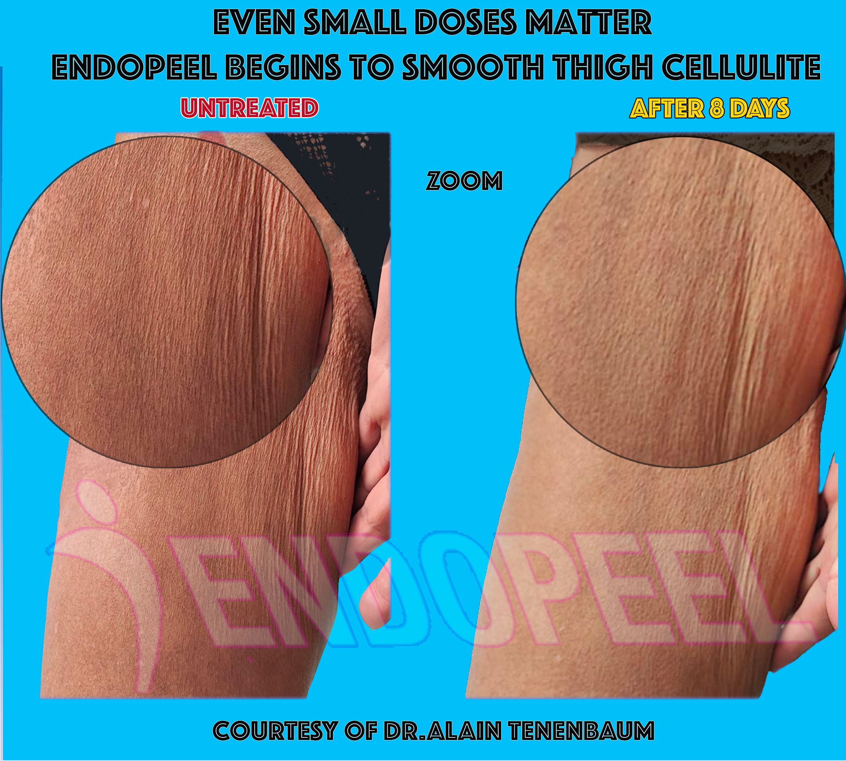 endopeel-thigh-lift-zoom
