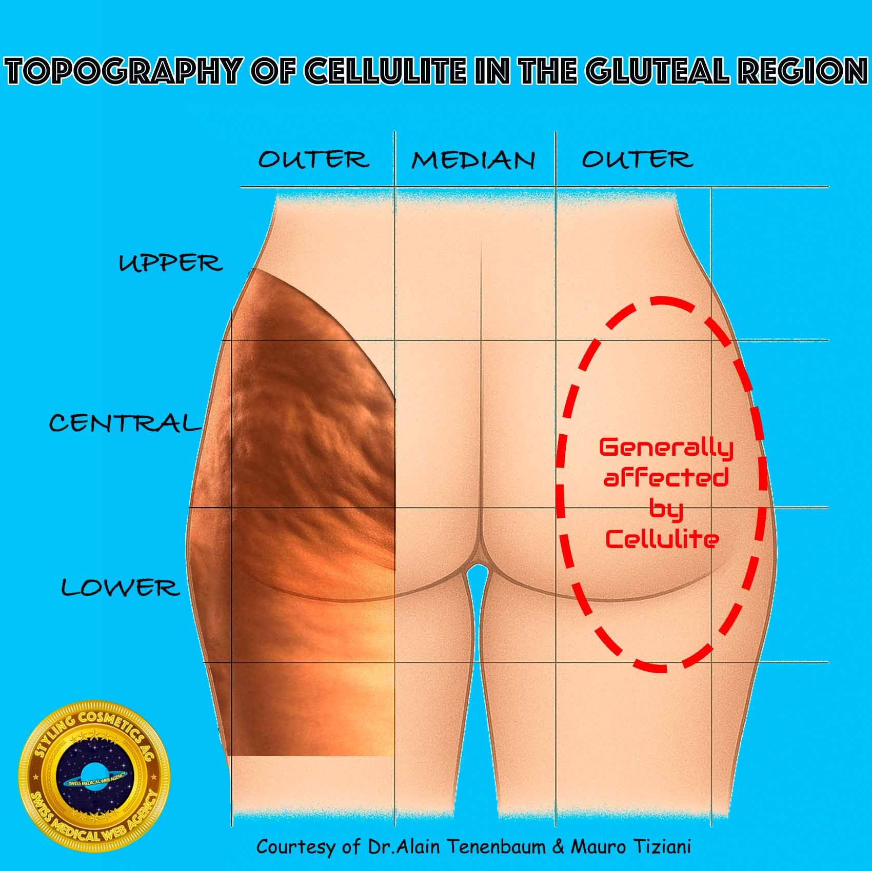 topography of cellulite in the gluteal region- affected areas
