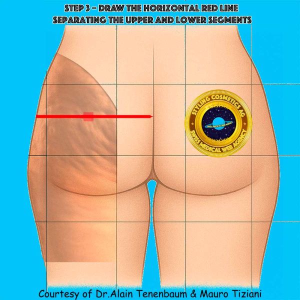 The horizontal red line divides the buttock into upper and lower segments. Tensor orientation changes across this line, as will be detailed in subsequent steps