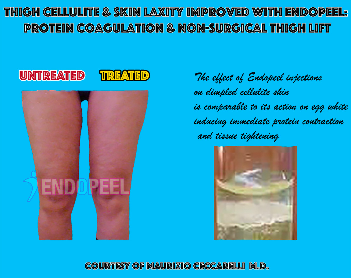 proteic-coagulation-with-endopeel