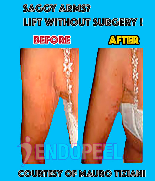 endopeel-upper-arm-contouring