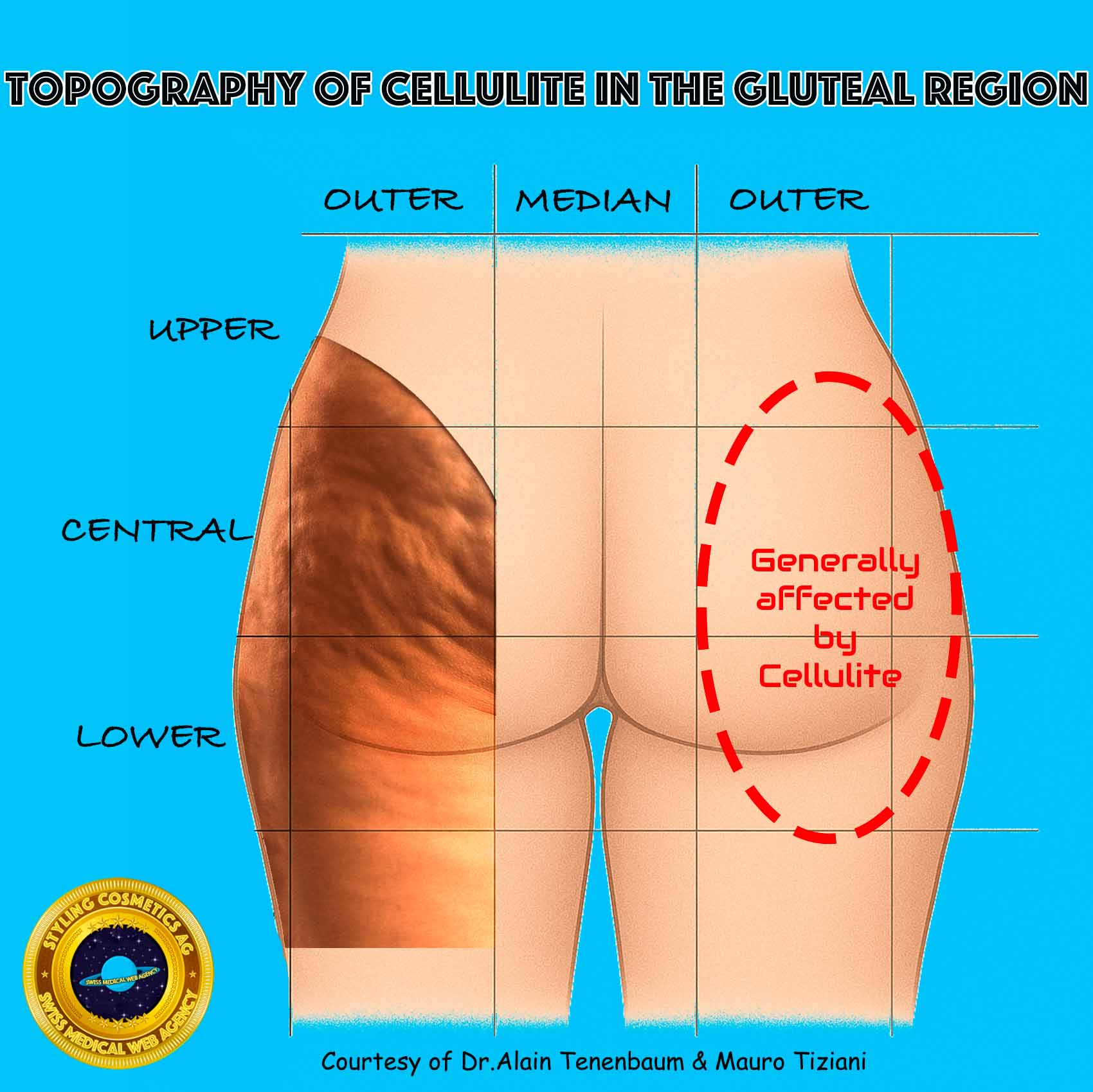 topography of cellulite in the gluteal region- affected areas