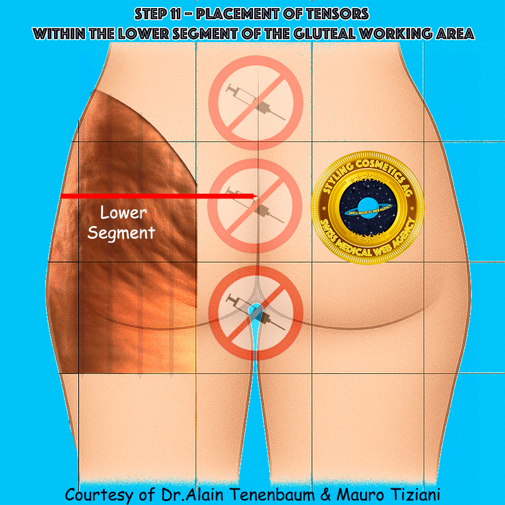 gluteal-techniques/step11