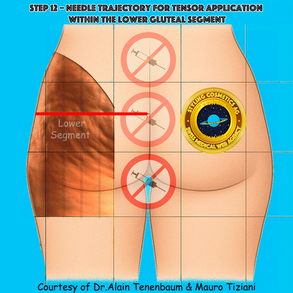 gluteal-techniques/step12