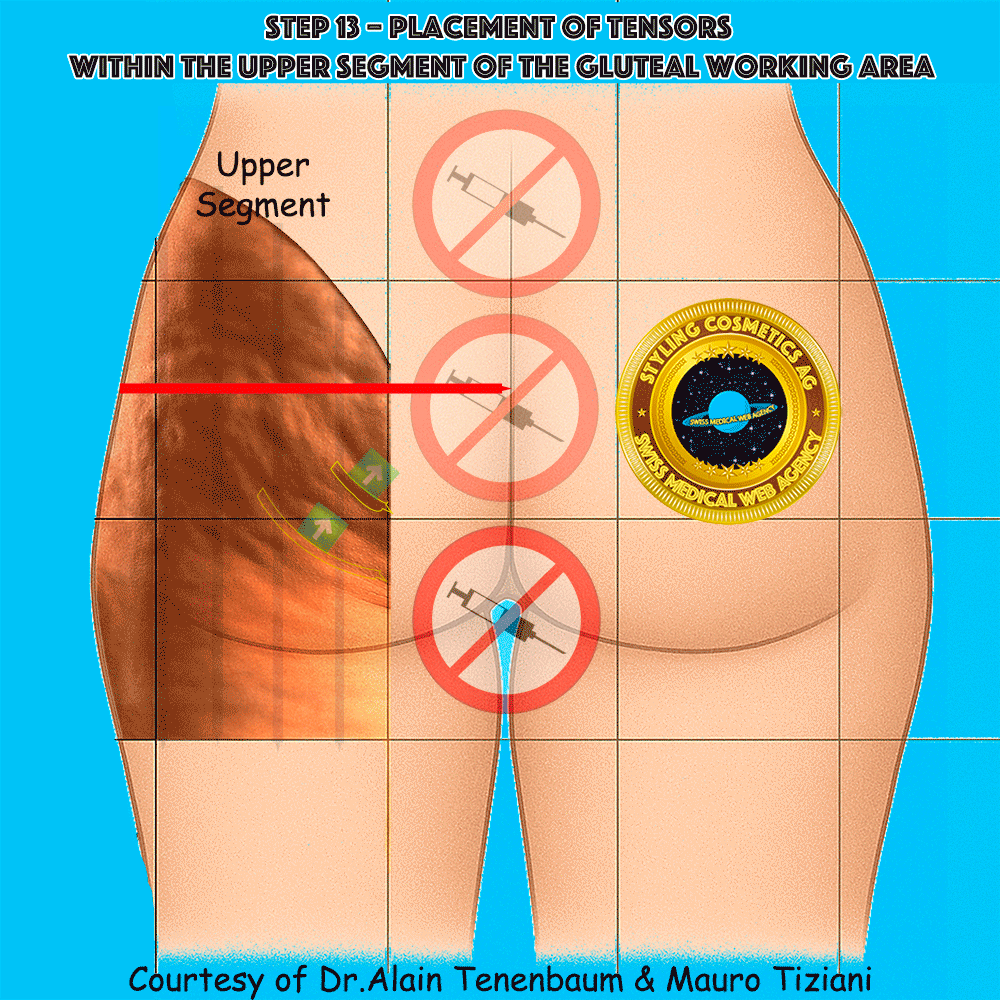 gluteal-techniques/step13