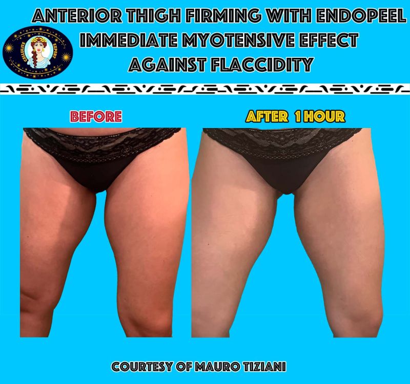 thighs flaccidity with endopeel