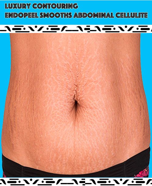 abdominal-cellulite