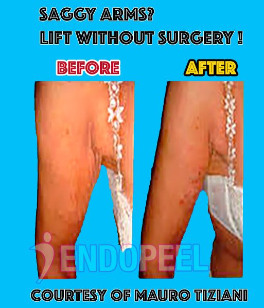 endopeel-upper-arm-contouring