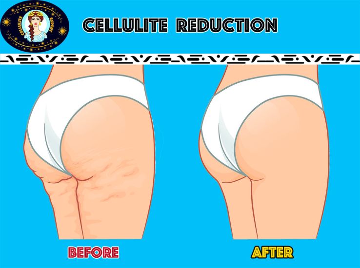 cellulite-reduction