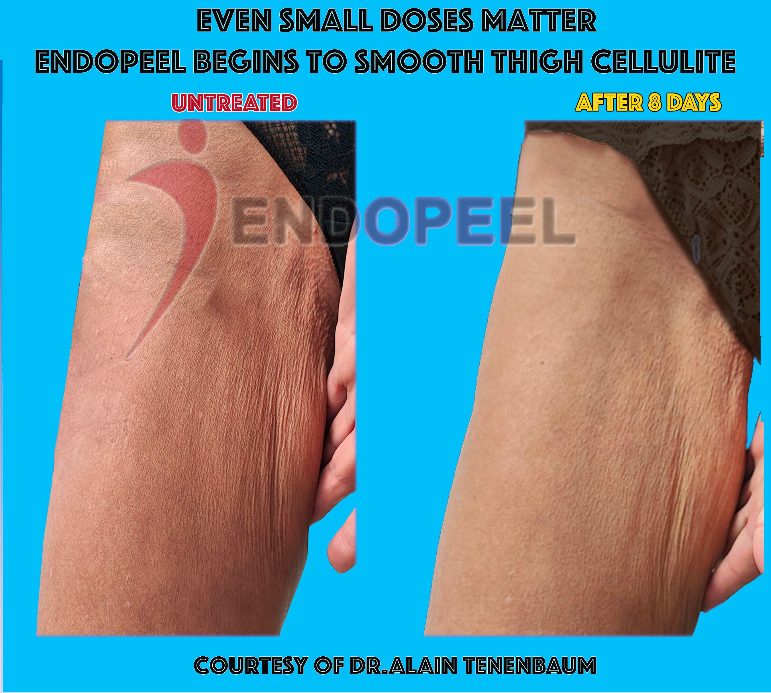 endopeel-thigh-lift