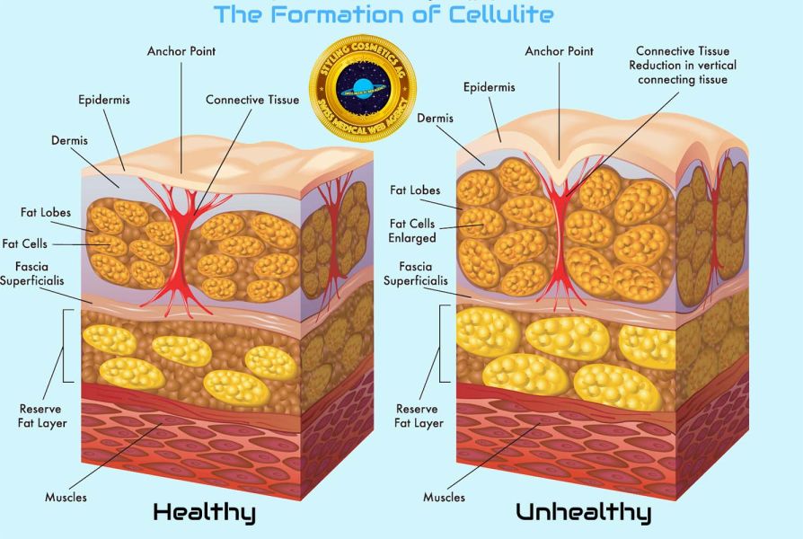 formation-cellulite